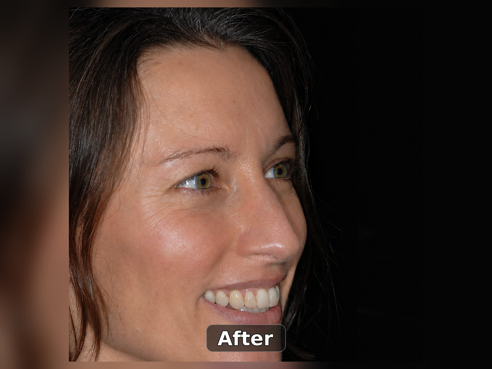 After smile transformation case 10