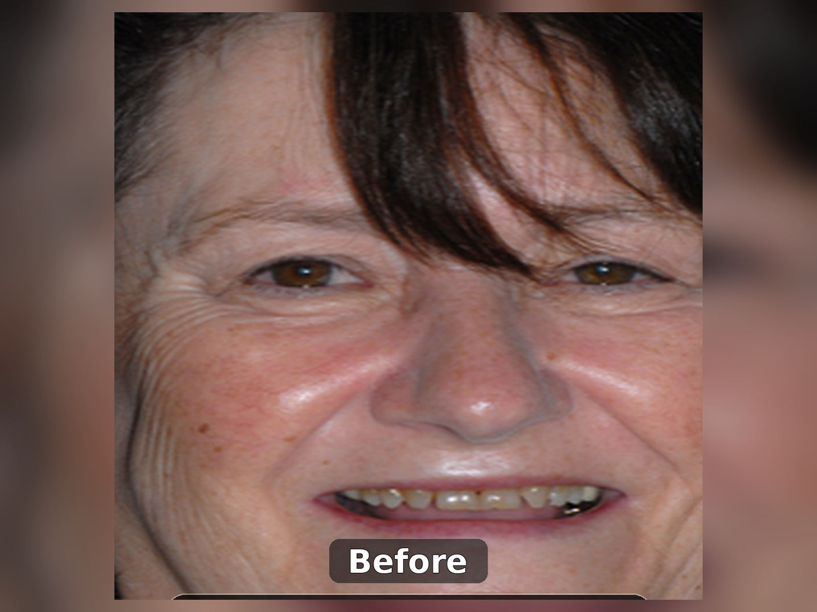 Before smile transformation case 3