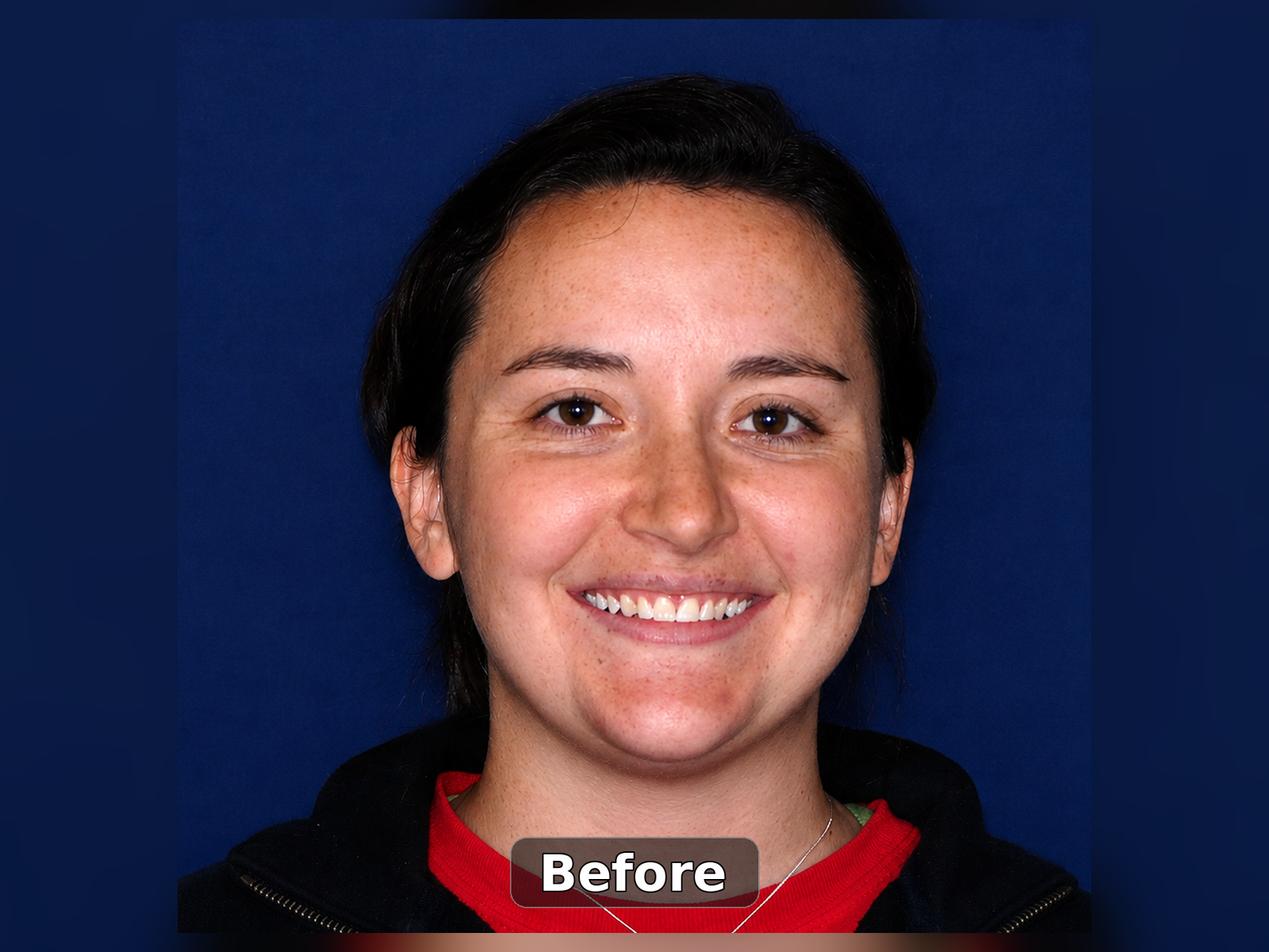 Before smile transformation case 9