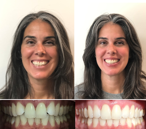 Before and after clear aligner results from Invisalign treatment